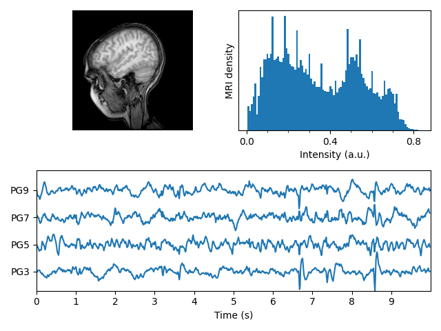 mri with eeg